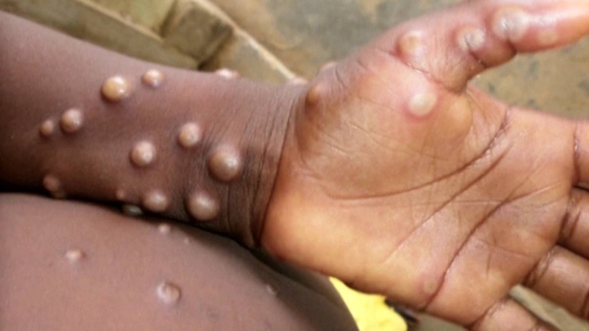 CDC Says Gay and Bisexual Men at Higher Risk of Contracting Monkeypox